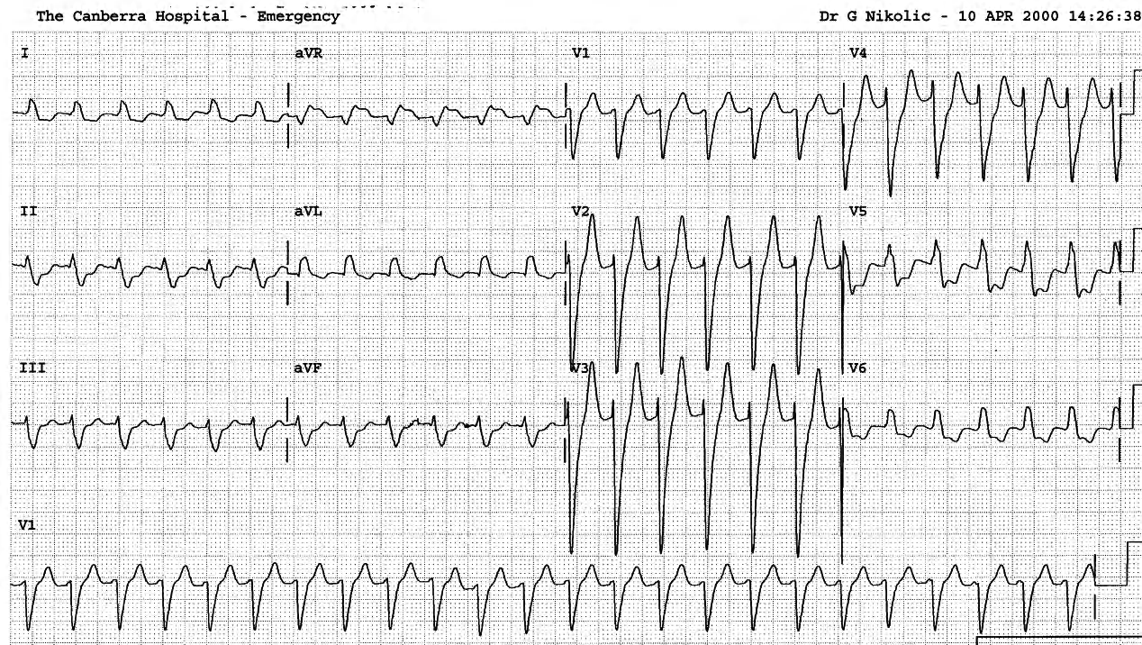 92 year old diabetic with chronic LBBB and heart failure secondary to hypertension and recurrent infarctions. 