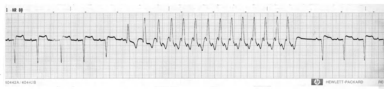 56 year old man recovering from pulmonary Ådema requiring prolonged mechanical ventilation. His jugular pulse made waves. 