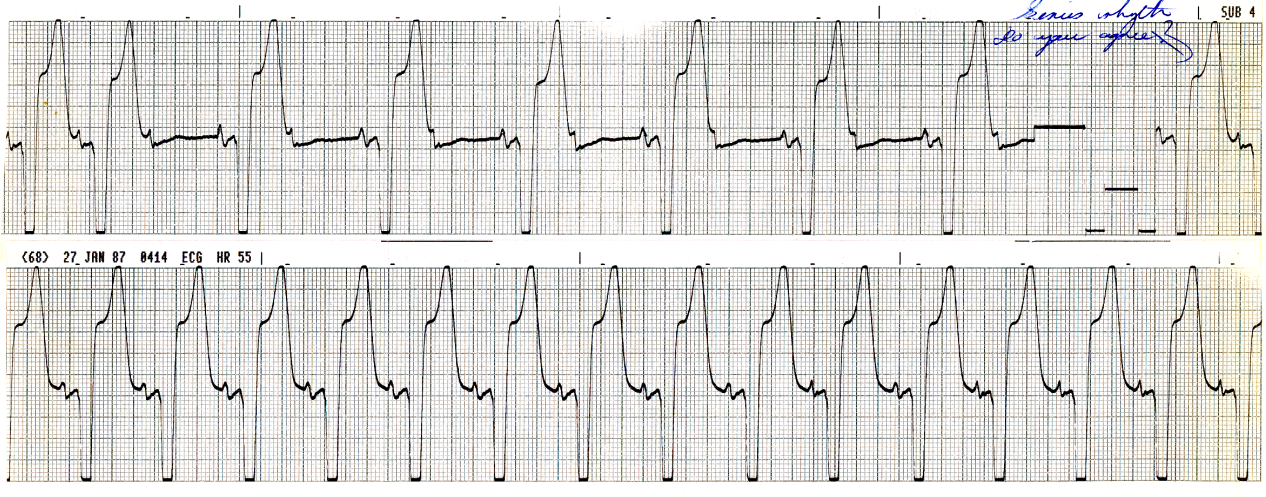 52 year old man with history of hypertension, admitted with dysphasia and hemiparesis. A CAT scan showed infarcts in the territory of the left anterior cerebral artery. What evidence is there of a bilateral bundle branch block (BBBB)? 