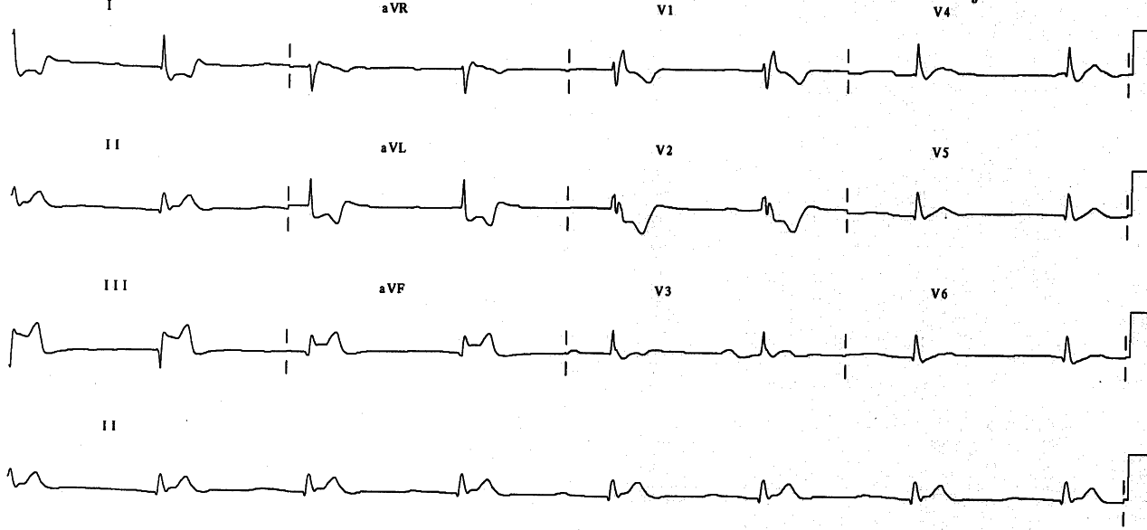 Ventilated 75 year old man with Guillain-Barre syndrome and cardiogenic shock causing acute renal failure.