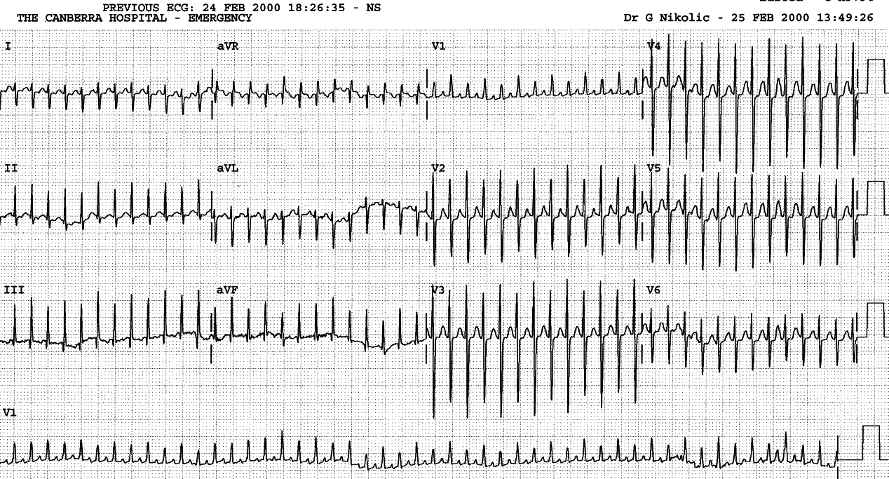 2 weeks old boy with very fast pulse and cardiac failure