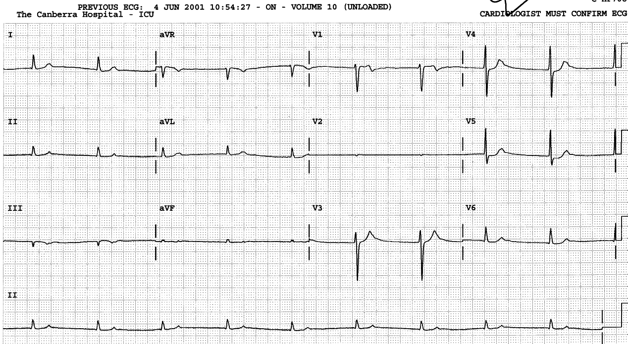 70 year old man treated in Casualty for diltiezam overdose