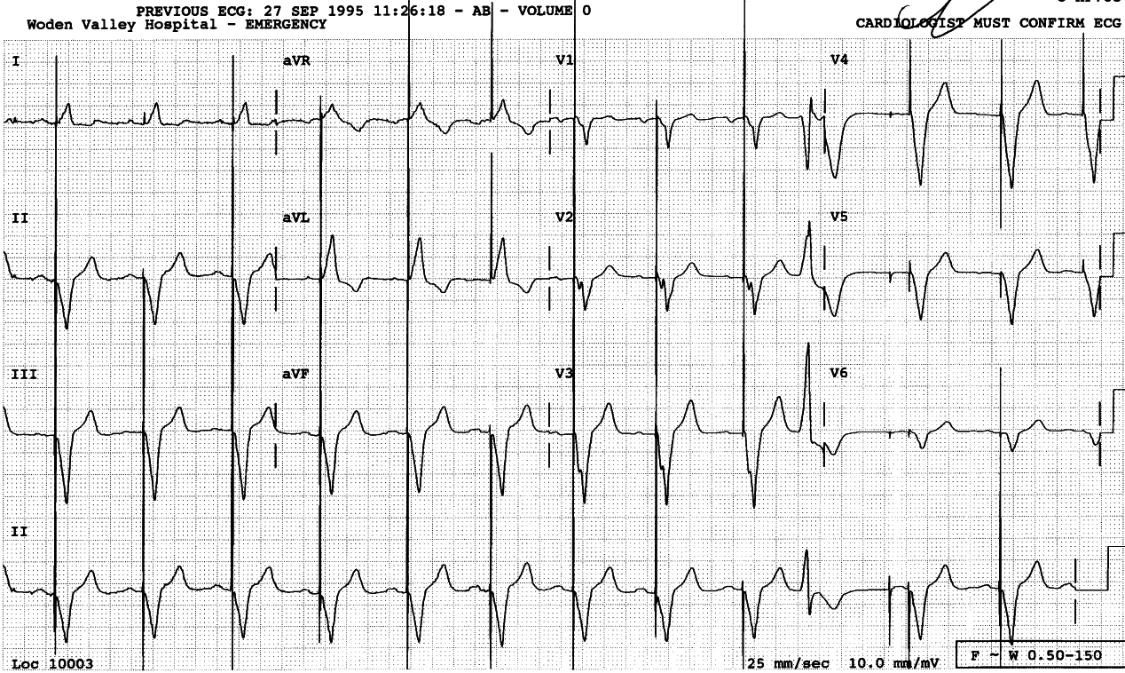 74 year old man with a permanent pacemaker.