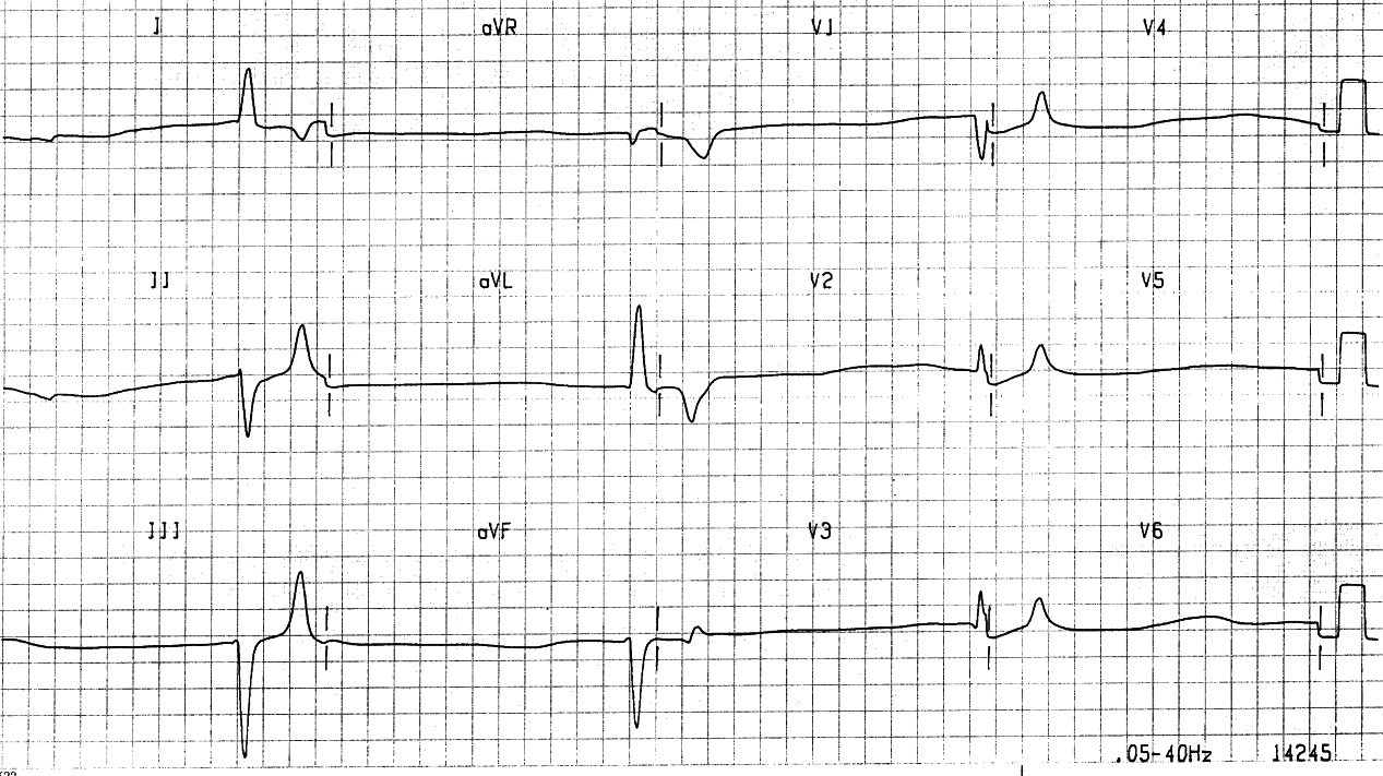 Another attempt to get more complexes on a 10-second ECG. 