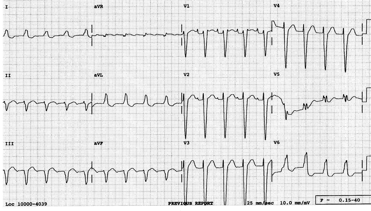 81 year old women with LBBB and rSr' pattern in V1. The trace was reported as sinus tachycardia with RBBB & LAHB by the computer, and with LBBB by a Cardiologist.