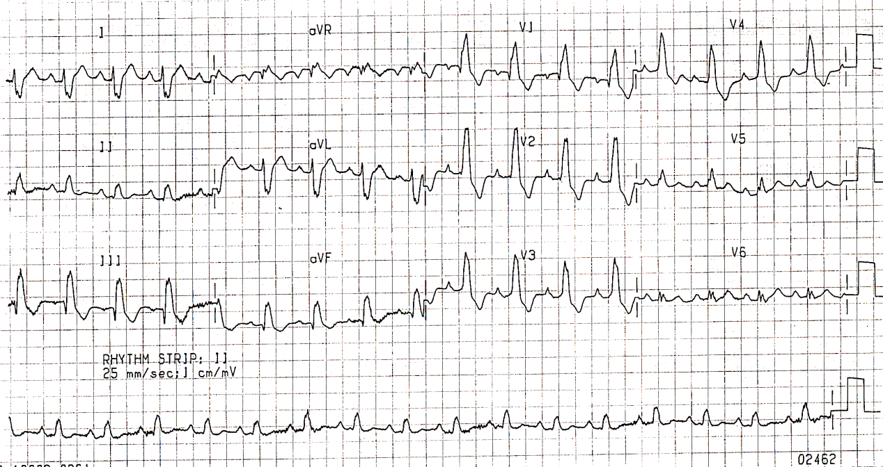 45 year old woman with severe rapidly progressive fibrosing alveolitis awaiting heart-lung transplantation