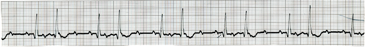 Ventricular standstill revealed what the previous strips concealed.