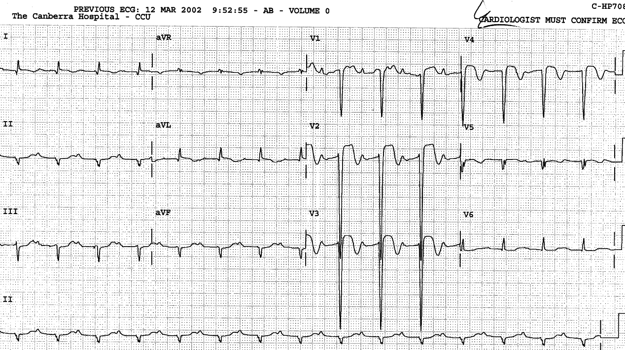 Day earlier, old inferior MI and 1o AVB coexist with acute anterior MI. The RBBB and LAHB in Fig 84 are superimposed on this.