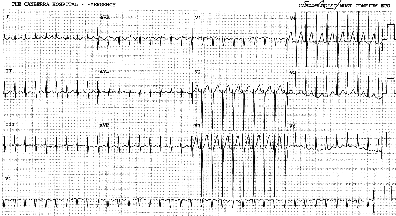 43 year old lady with âracing heartâ