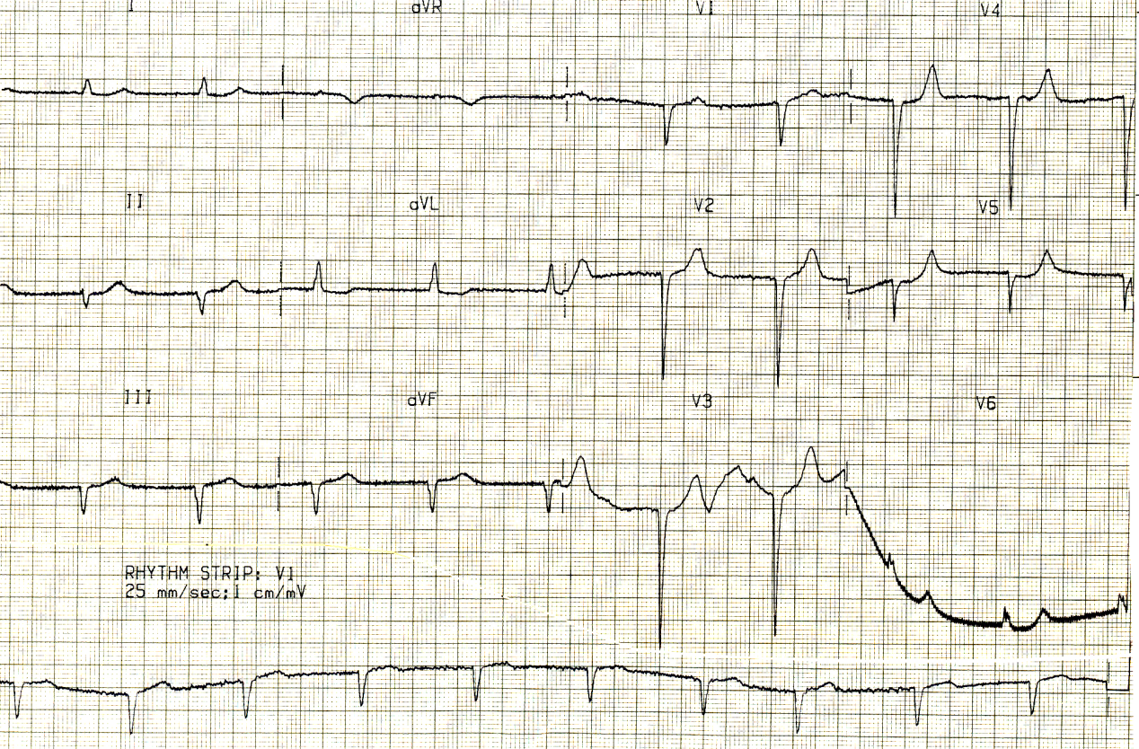 Old anterior and, possibly, inferior MI; maybe there is no hemiblock causing the LAD.