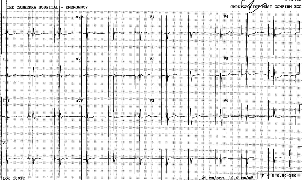 Routine ECG of a 77 year old lady with atypical chest pains.
Should anything be done?