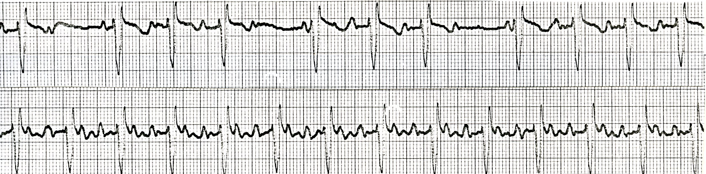 59 year old alcoholic recently digitalised for congestive cardiomyopathy. He has persistent nausea and vomiting. Later that day, he starts vomiting blood. What is the most likely diagnosis? What is the most likely ECG diagnosis? 