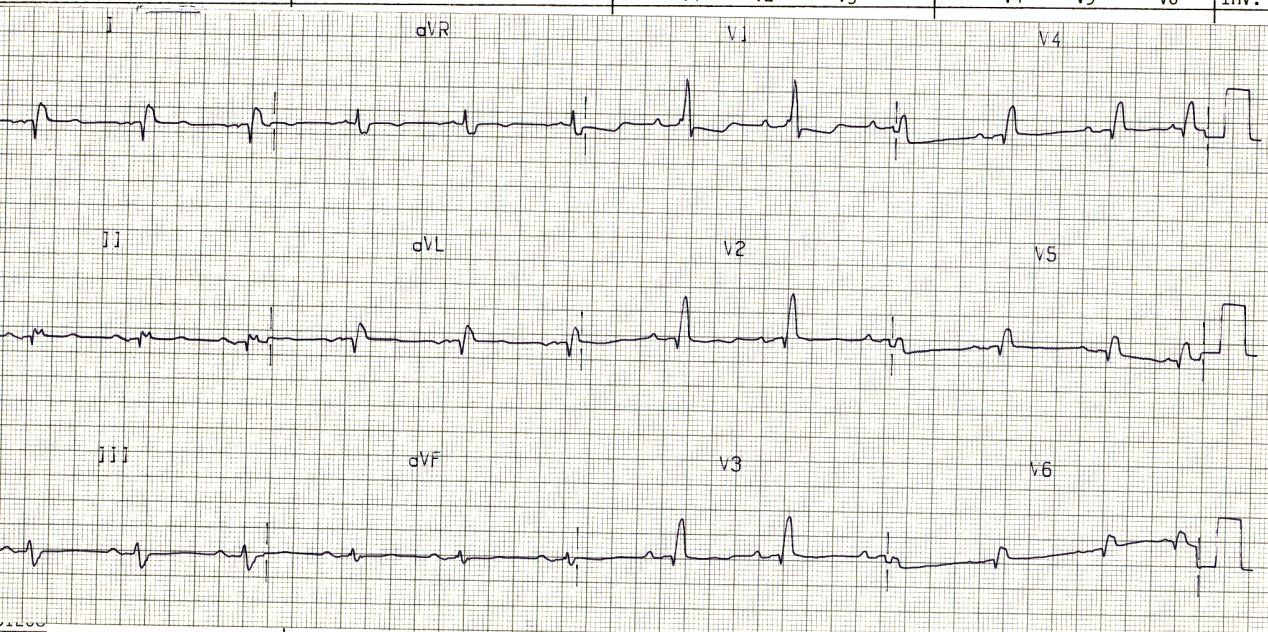 69 year old man in the ICU following a nephrectomy complicated by hÃ¦morrhagic shock