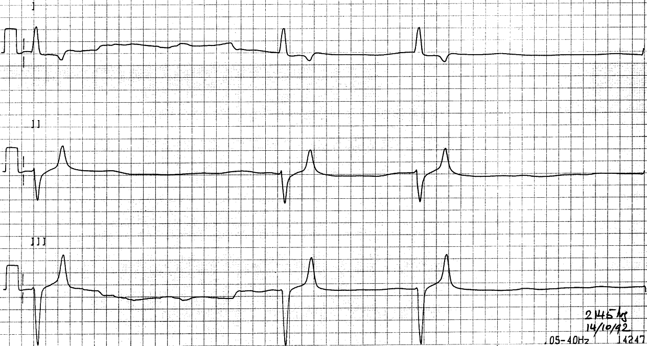 69 year old woman in Casualty with weakness and pre-syncope. 