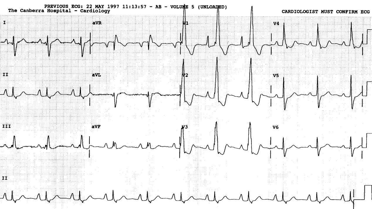 Cyanosed 39 year old lady with history of Blalockâs shunt for tetralogy of Fallot