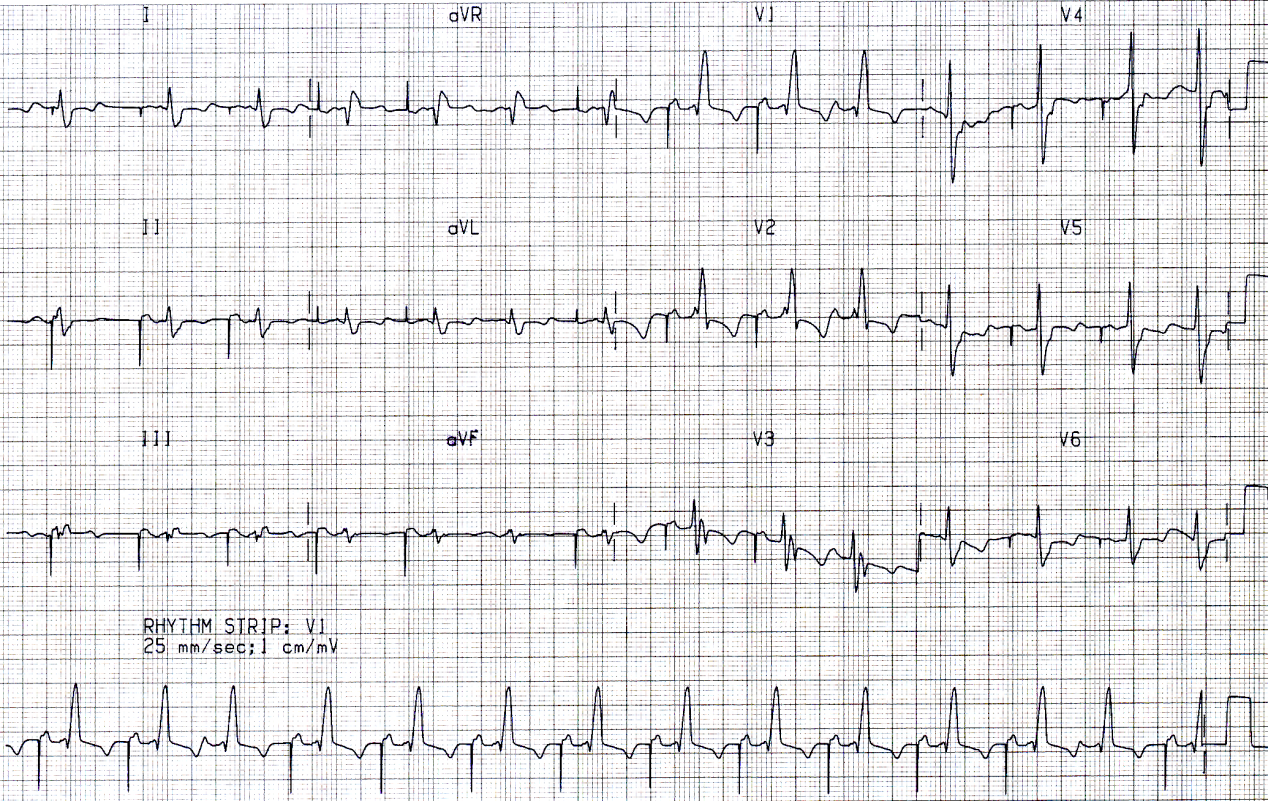 The rhythm strip is not synchronous with the 12-lead channels. ST/T changes connote ischÃ¦mia.