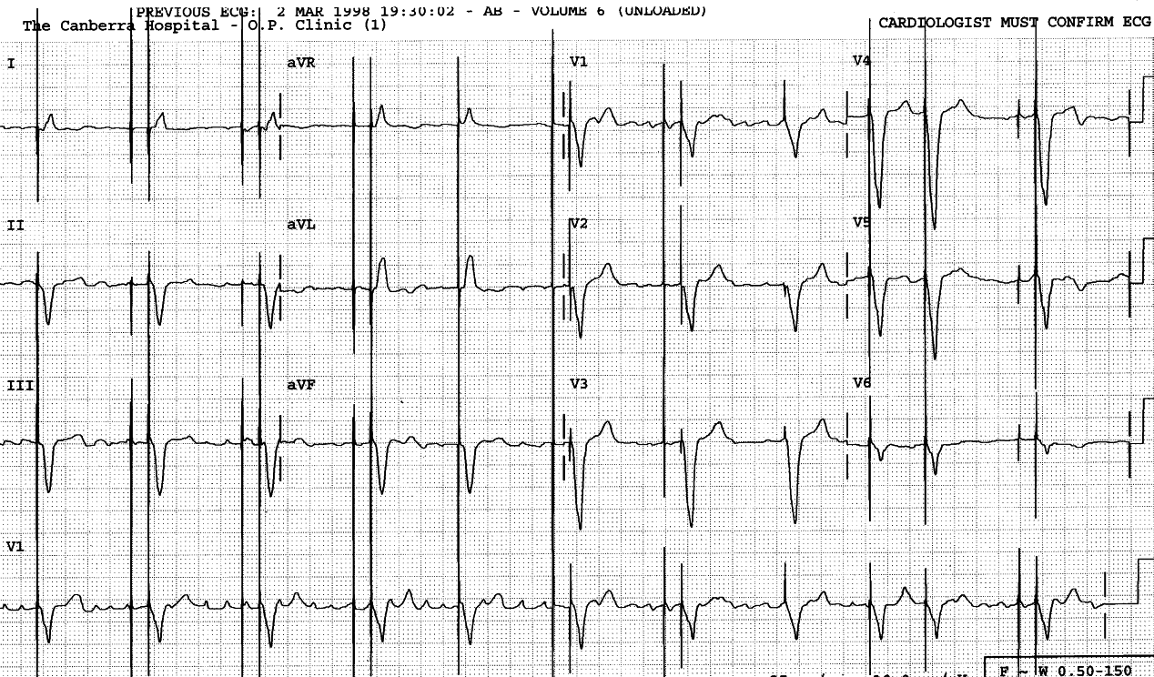 73 year old man with permanent pacemaker and recent
worsening of congestive cardiac failure.