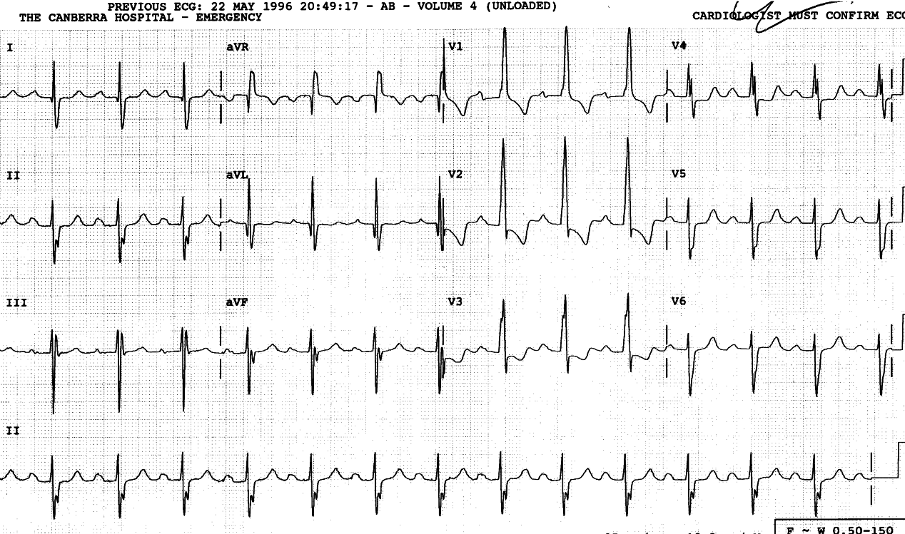 28 year old nurse with cyanosis and pulmonary hypertension