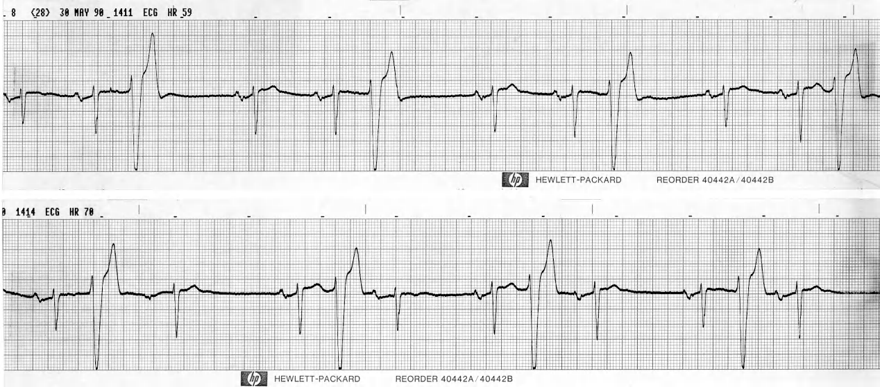 CCU monitor strips of a 59 year old man with unstable angina: two forms of trigeminy. 