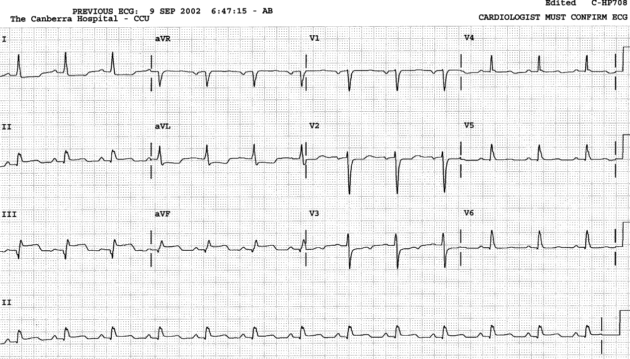 Sinus rhythm and the expected voltage loss with evolving inferior MI.