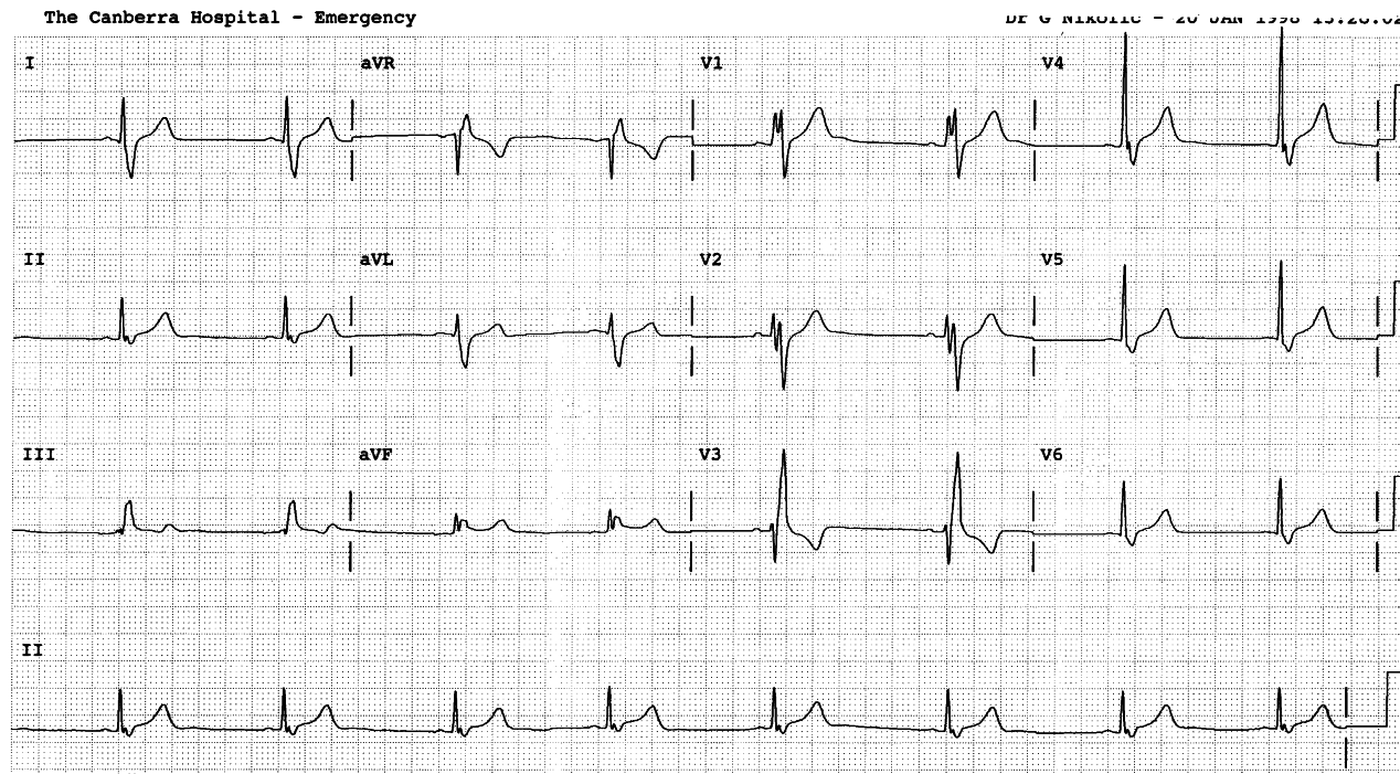 18 year old boy in Casualty with pharyngitis and vague chest pains