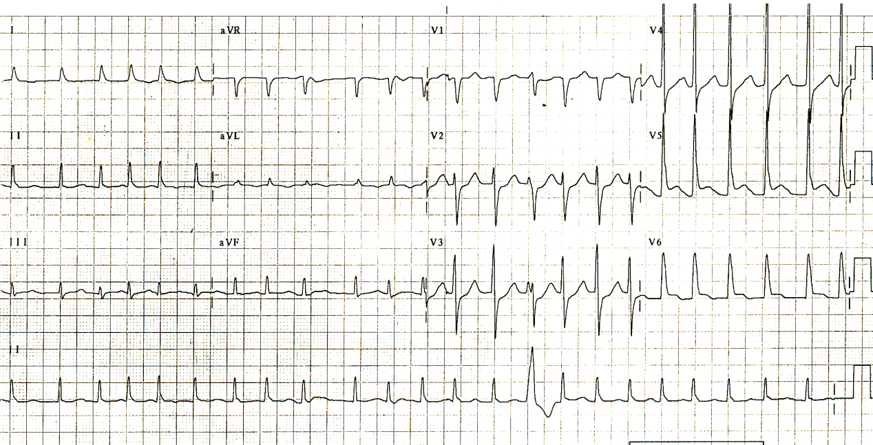 84 year old woman with large embolic fronto-parietal CVA