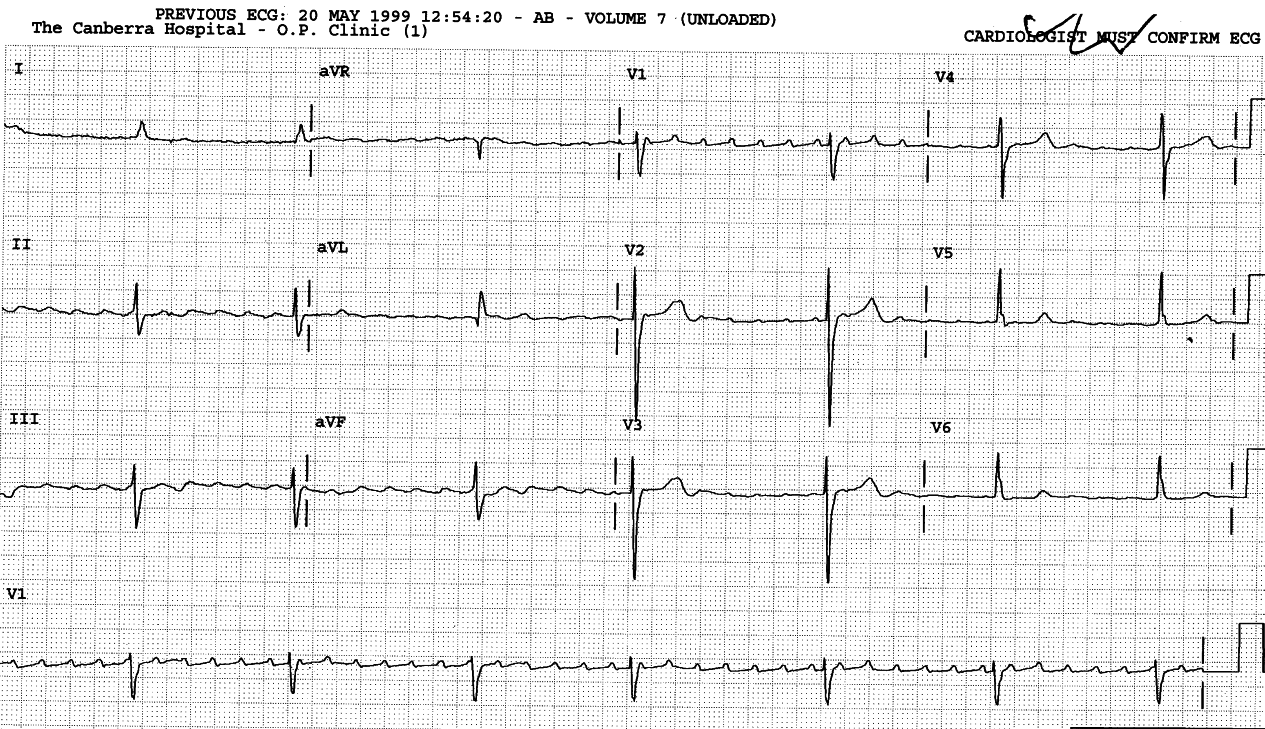 Asymptomatic 74 year old man in CCU.  