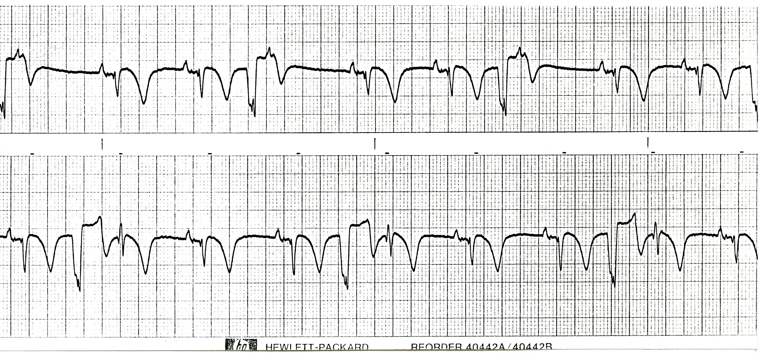 What happens when every third P wave is, more or less, blocked. 