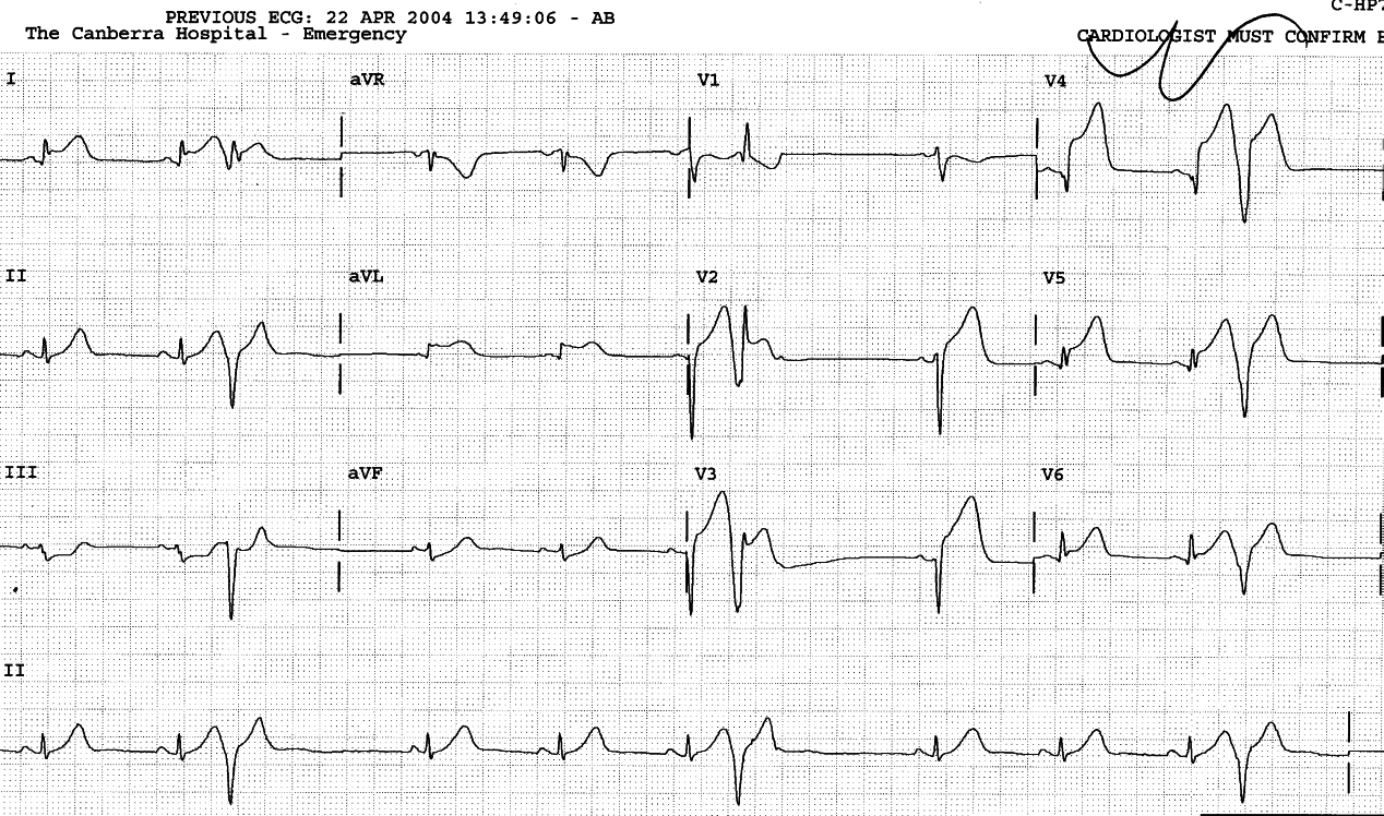 57 year old man with chest discomfort, blissfully unaware of Bernard Lownâs classification of VEBs..