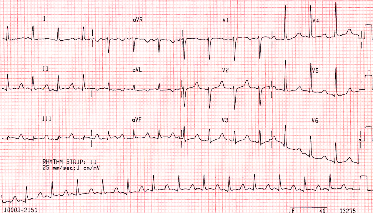 63 year old binge drinker presenting with abdominal distension and 3-day history of vomiting. The biochemical profile includes Na 126, K 3.4, creatinine 385, urea 32, bilirubin 14, albumin 35, GGT 60, ALT 54, ALP 103, amylase 102, lipase 265, Ca 0.67, Mg 1.06. With FIO2 0.28, PO2 is 57, PCO2 37 and pH 7.45. CXR is clear. He is admitted to CCU. Why?