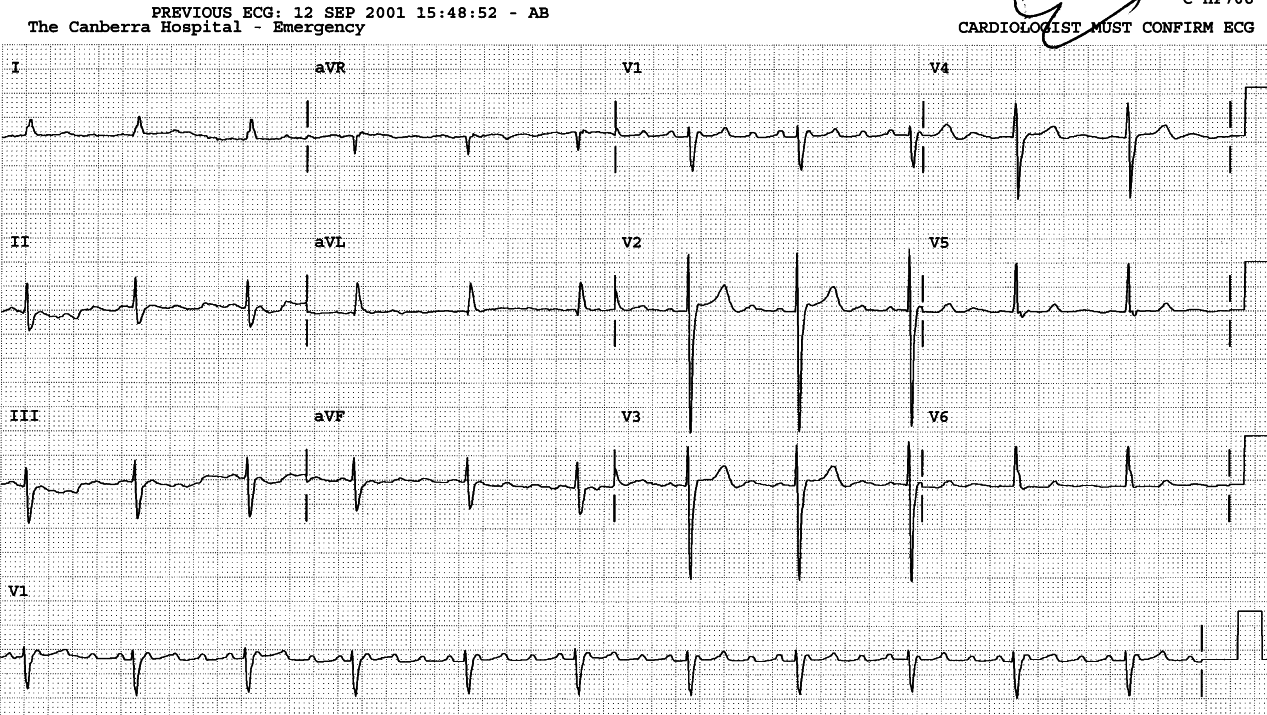 Atrial flutter with 4:1 block. Prominent U wave is seen in     V4, for any of the (un)known reasons. 