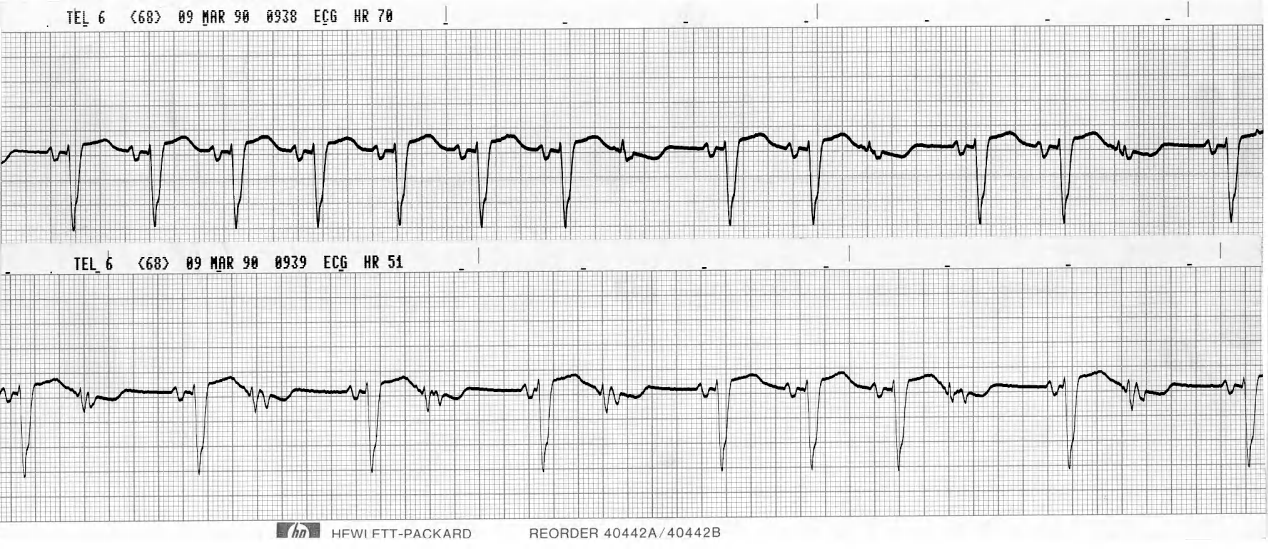 Telemetry readouts of a 49 year old man with recent anterior infarction. 