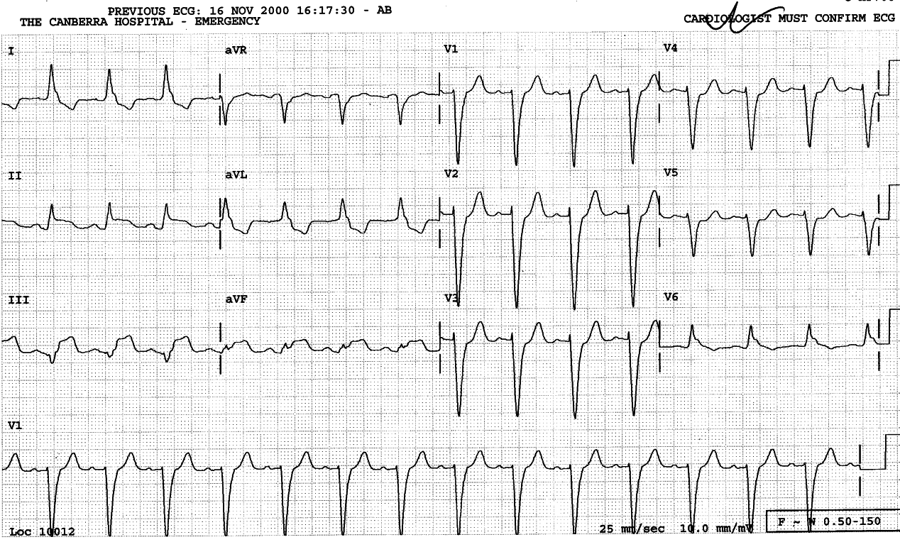 73 year old lady with chest pain.