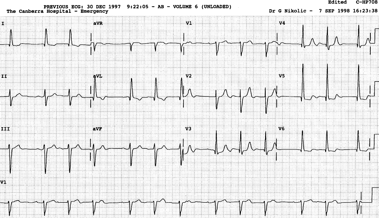 Variable Wenckebach 2o AVB. There is
probably LVH with ST/T changes, modified by LAHB.