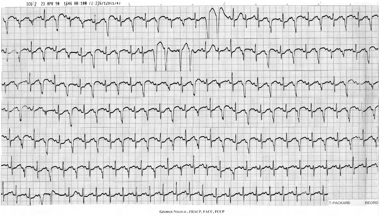 Effects of 1 mg adrenaline IV in a 77 year old lady with septic shock. Her BP rose from 40/20 to 236/128 mmHg. 