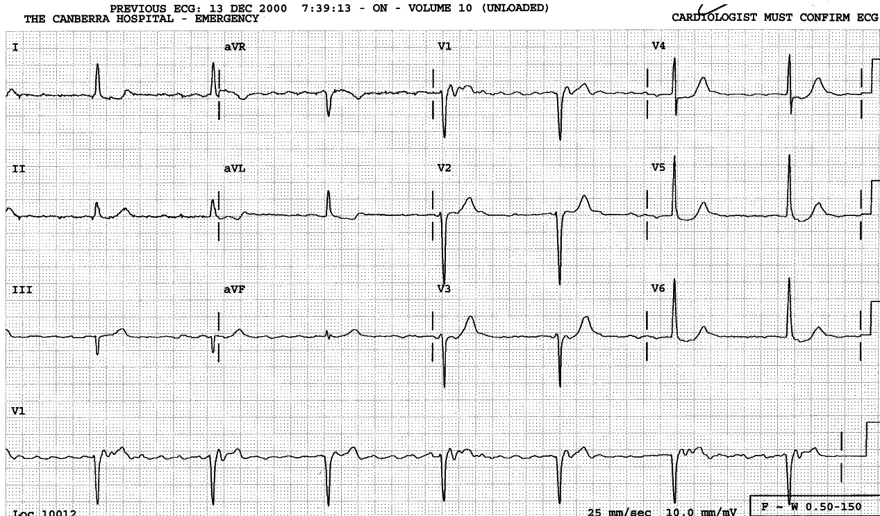 73 year old man with bradycardia and fatigue. 