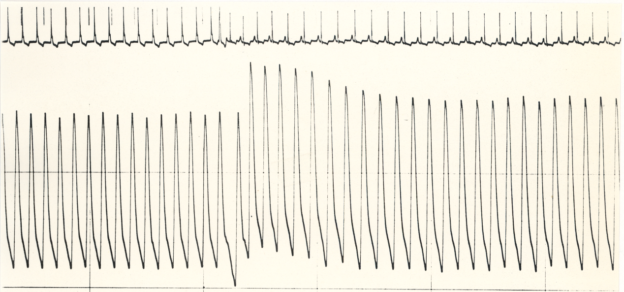 Aortic root recording in a 40 year old man with aortic incompetence. What accounts for the sudden rise in blood pressure?