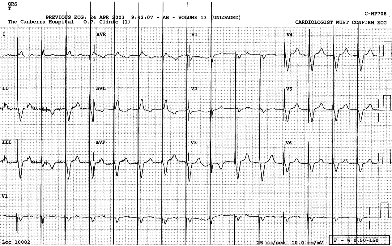 82 year old lady with permanent VVIR
pacemaker; its magnet rate was set at 85/min.