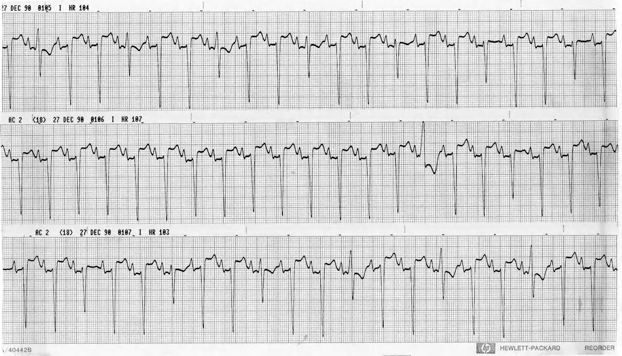 CCU strips of a 42 year old man with COCM on dobutamine infusion. 