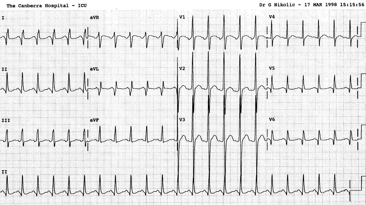 17 year old boy with myopathy since early childhood, now ventilated for respiratory failure