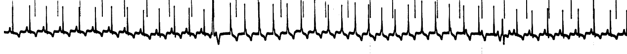 Ventricular systole coincides with the T wave on the ECG.