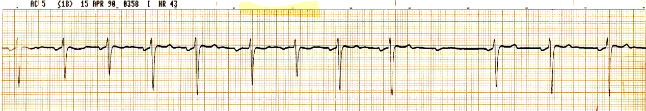 Obese 30 year old heavy smoker with presumptive sleep apnÅa,     asleep in CCU. His 12-lead ECG showed persistent T wave inversion in the     anterolateral leads, but the coronary angiogram was normal. The strip     shown below prompted a request for polysomnography which stated that the     2o AV block may have been caused by a spell of apnÅa. What do     you think of this? 