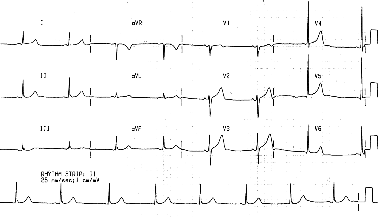 64 year old man with left-sided chest pain and history of hypertension. Should he be given streptokinase on admission?