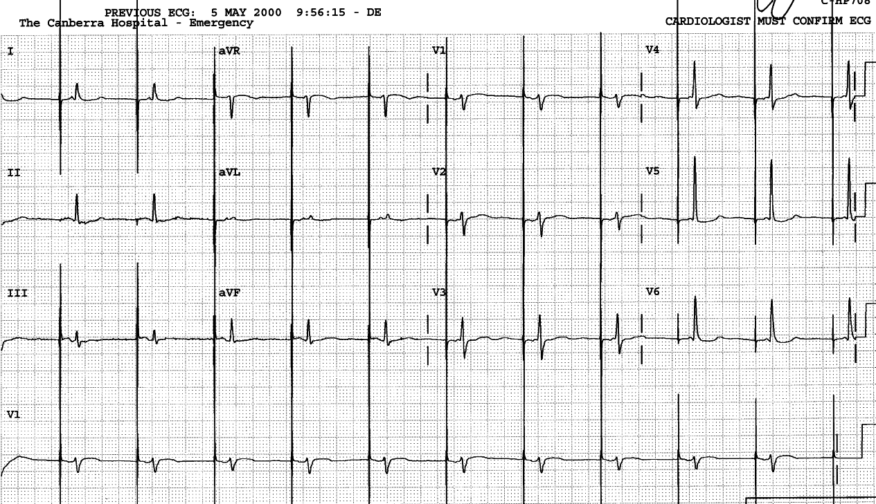 Atrial pacing with longer AV interval: the native QRS
inhibits the ventricular spike.