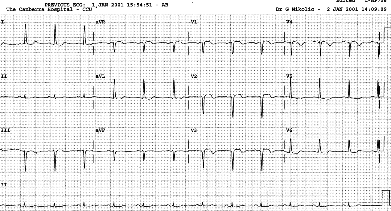 74 year old lady with chest pain.