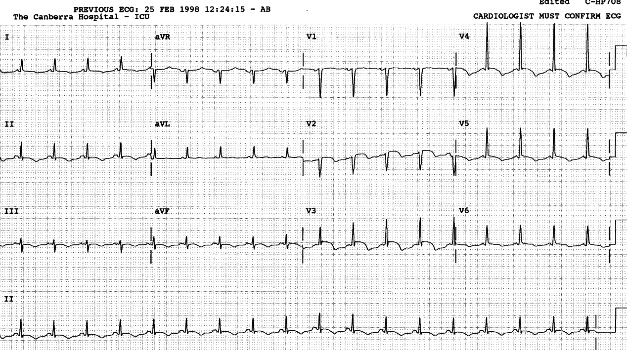 QT prolongation too late to be of diagnostic value in this case.