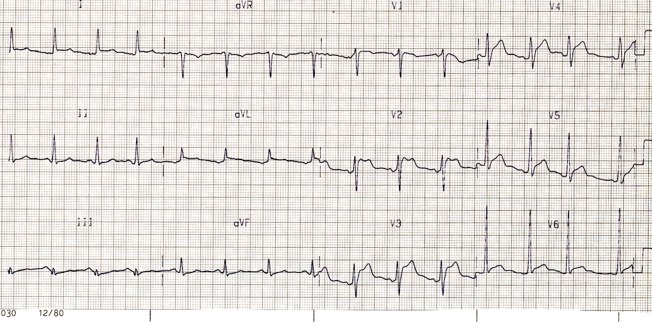 Day 2 post left upper lobectomy in asymptomatic 62 year old man with mild hypertension and history of atrial flutter. List 3 ECG abnormalities present and comment on their significance.