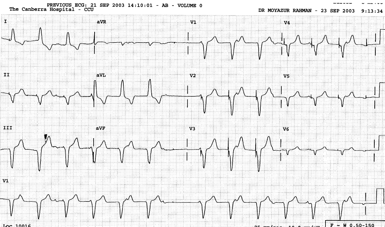 84 year old man with temporary pacemaker in CCU
following inferior infarction.