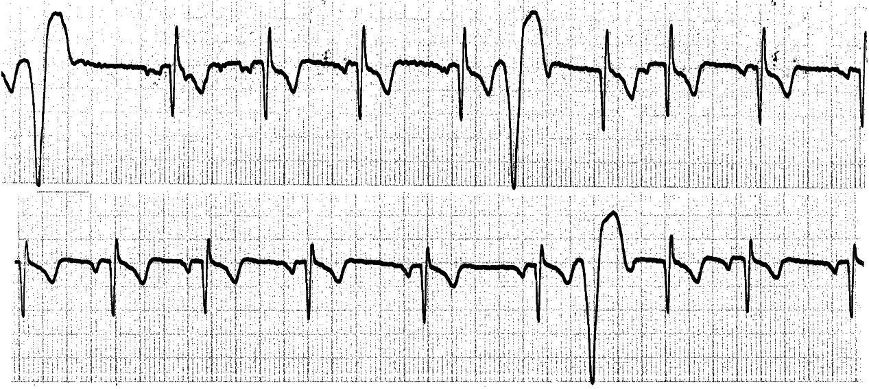 Sinus P     waves are undisturbed except for sinus arrhythmia.