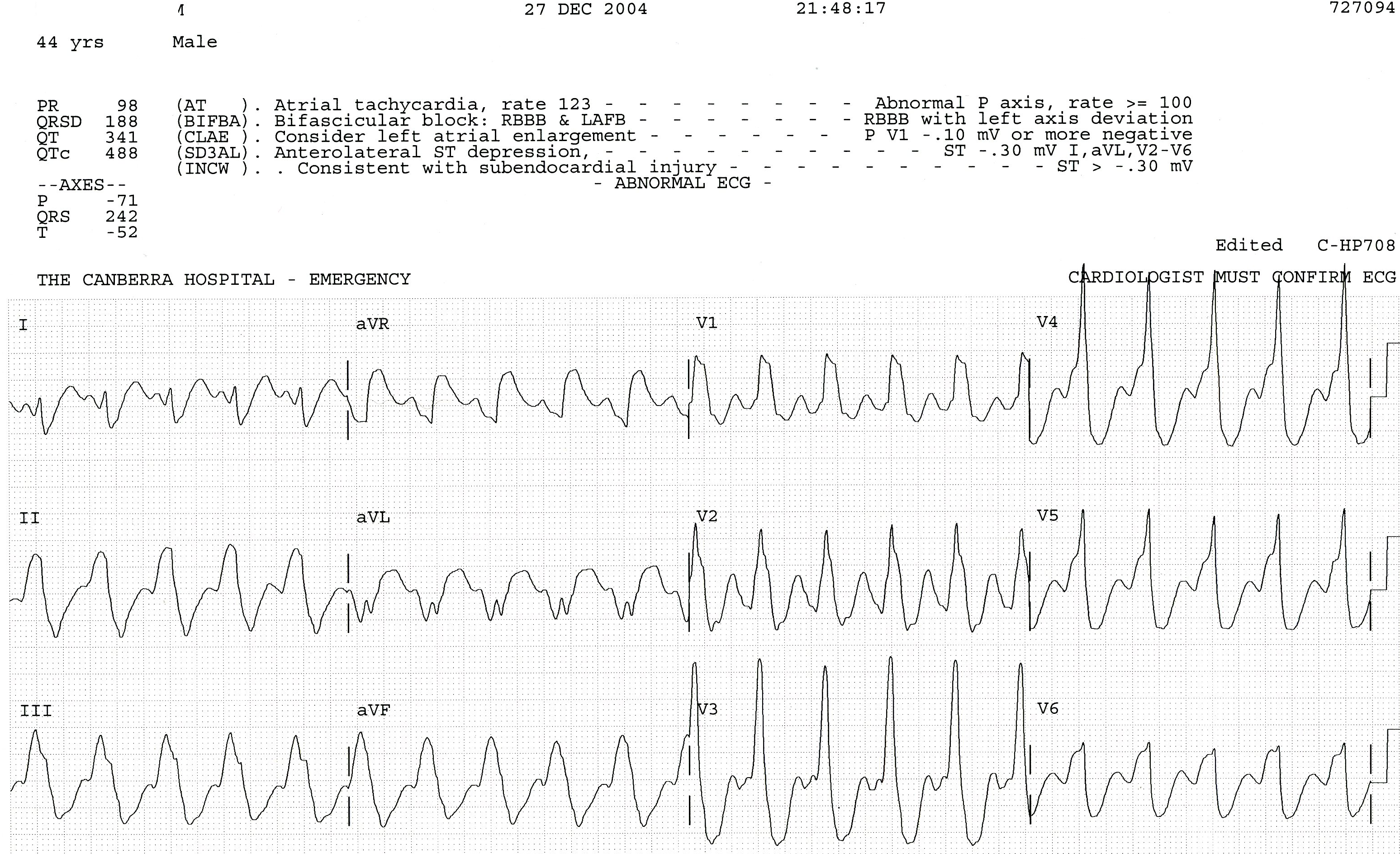 Pseudo P waves in lead 1 misled the computer. 